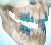 Российские ученые разработали уникальную технологию восстановления зубной эмали