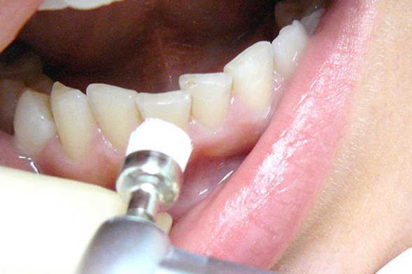 Профессиональная чистка зубов с помощью технологий