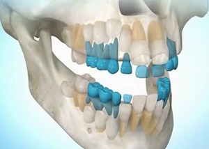 Российские ученые разработали уникальную технологию восстановления зубной эмали